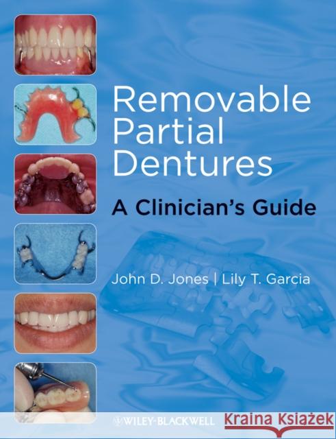 Removable Partial Dentures: A Clinician's Guide Jones, John D. 9780813817064 Blackwell Publishers