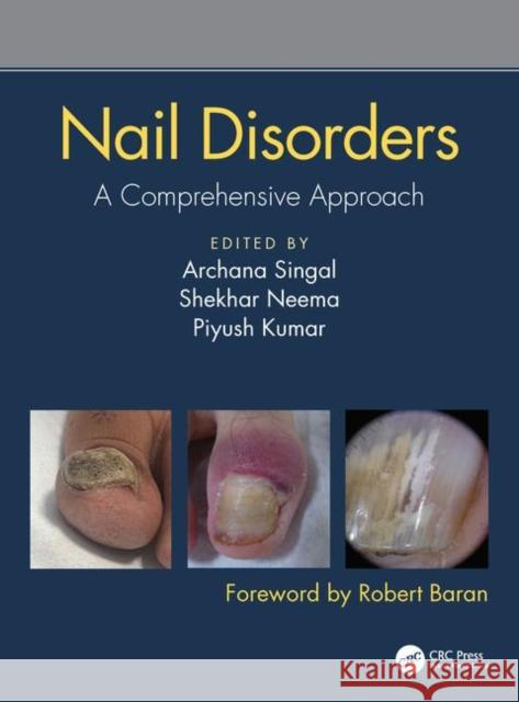 Nail Disorders: A Comprehensive Approach Archana Singal Shekhar Neema Piyush Kumar 9780815378341 CRC Press