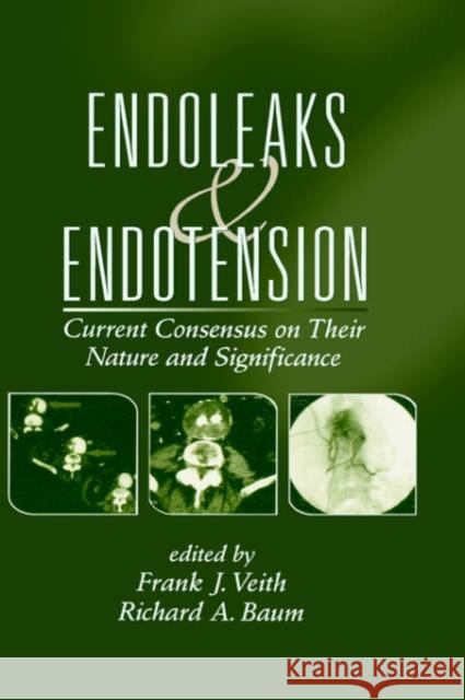 Endoleaks and Endotension: Current Consensus on Their Nature and Significance Veith, Frank J. 9780824709549 Informa Healthcare
