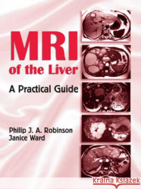 MRI of the Liver : A Practical Guide Philip J. A. Robinson Ward Janice 9780824728717 Informa Healthcare