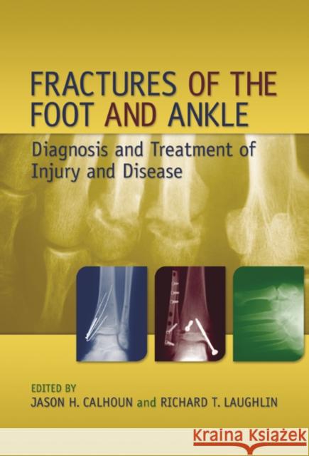 Fractures of the Foot and Ankle : Diagnosis and Treatment of Injury and Disease Calhoun Laughli                          Calhoun H. Calhoun Richard T. Laughlin 9780824759162 