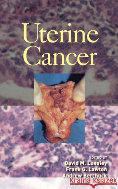 Uterine Cancer David M. Luesley Frank Lawton Andrew Berchuck 9780824759513 Marcel Dekker