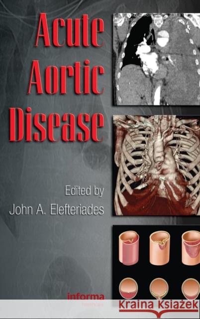 Acute Aortic Disease John A. Elefteriades 9780849370236