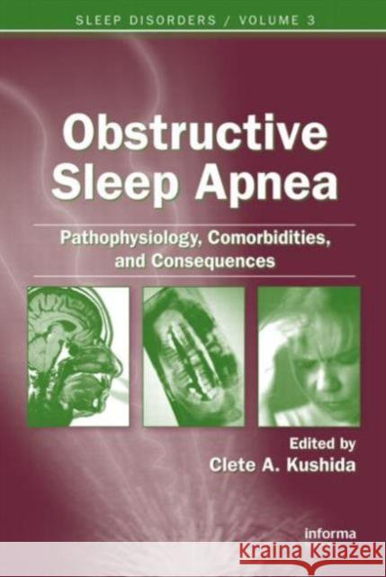 Obstructive Sleep Apnea: Pathophysiology, Comorbidities and Consequences: Pathophysiology, Comorbidities, and Consequences Kushida, Clete A. 9780849391804 Informa Healthcare