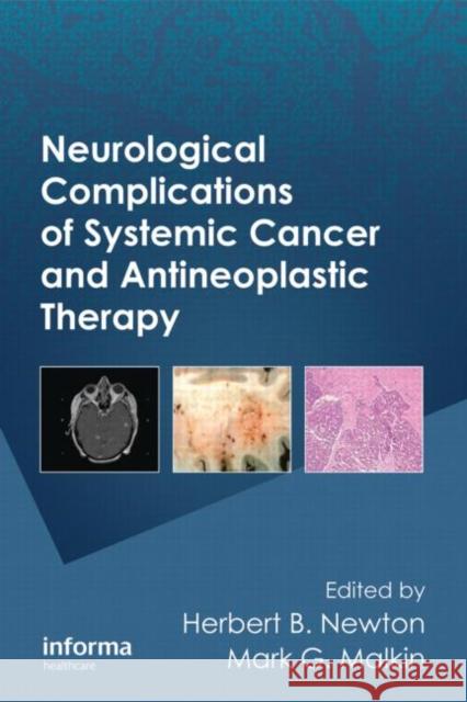 Neurological Complications of Systemic Cancer and Antineoplastic Therapy Newton B. Newton Herbert B. Newton Herbert B. Newton 9780849391910 Informa Healthcare