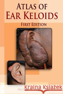 Atlas of Ear Keloids Michael H. Tirga 9780985655372 Michael H. Tirgan