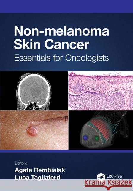 Non-Melanoma Skin Cancer: Essentials for Oncologists Agata Rembielak Luca Tagliaferri 9781032127415 CRC Press