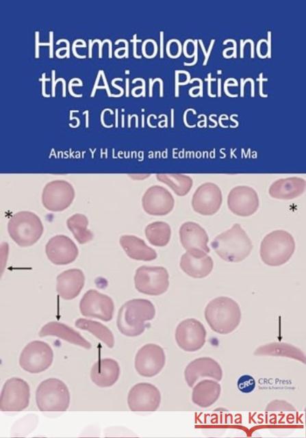 Hematology and the Asian Patient: 51 Clinical Cases Anskar Y. H. Leung Edmond S. K. Ma 9781032351254 CRC Press