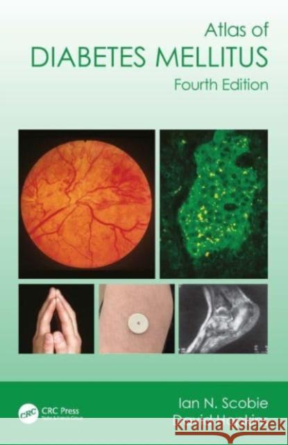 Atlas of Diabetes Mellitus David (University of Glasgow, UK) Hopkins 9781032379456 Taylor & Francis Ltd