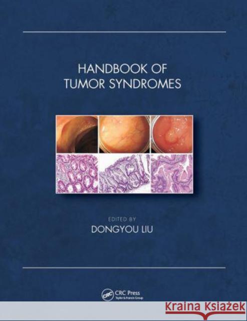 Handbook of Tumor Syndromes Dongyou Liu (Royal College of Pathologis   9781032400044 Taylor & Francis Ltd