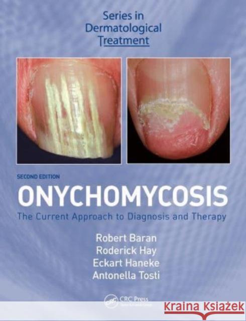 Onychomycosis: The Current Approach to Diagnosis and Therapy Robert Baran Roderick Hay Eckart Haneke 9781032477862 CRC Press