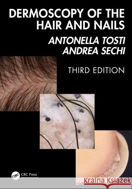 Dermoscopy of the Hair and Nails 3e Antonella Tosti Andrea Sechi 9781041020028 CRC Press