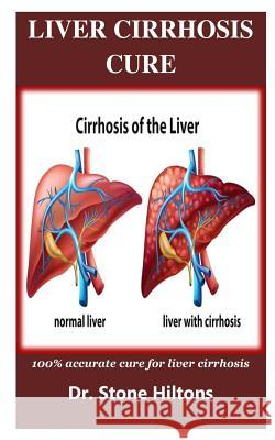 Liver Cirrhosis Cure: 100% accurate cure for liver cirrhosis Hiltons 9781075802454 Independently Published