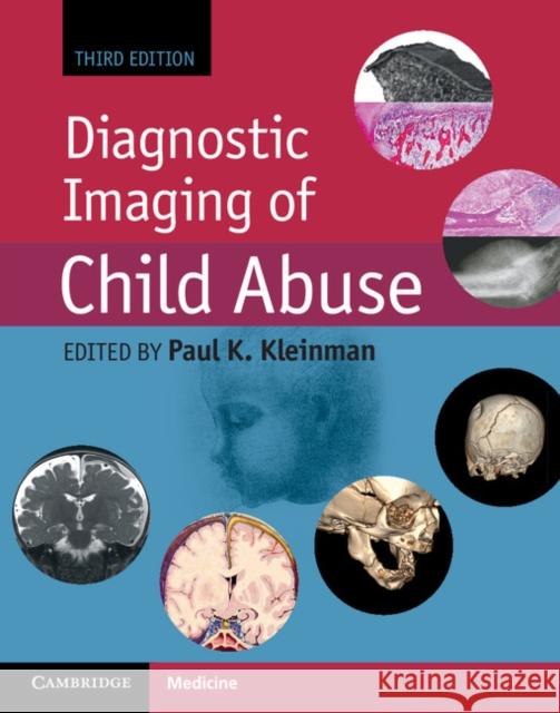 Diagnostic Imaging of Child Abuse Paul Kleinman 9781107010536 Cambridge University Press