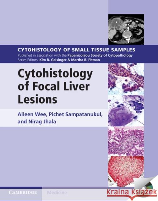 Cytohistology of Focal Liver Lesions Aileen Wee Pichet Sampatanukul Nirag Jhala 9781107024175