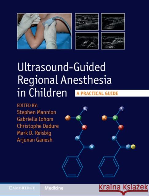 Ultrasound-Guided Regional Anesthesia in Children: A Practical Guide Stephen Mannion Arjunan Ganesh Gabrielle Iohom 9781107098770