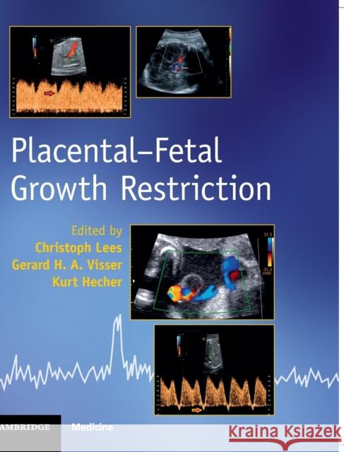 Placental-Fetal Growth Restriction Christoph Lees Gerard H. a. Visser Kurt Hecher 9781107101395 Cambridge University Press