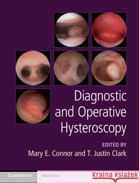 Diagnostic and Operative Hysteroscopy Mary E. Connor, T. Justin Clark 9781107111608 Cambridge University Press