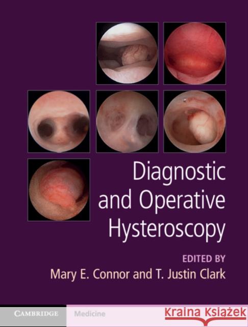 Diagnostic and Operative Hysteroscopy Mary E. Connor, T. Justin Clark 9781107111608