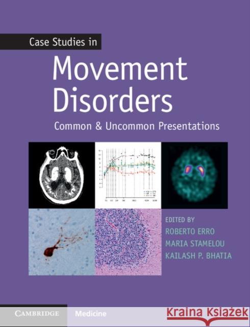 Case Studies in Movement Disorders: Common and Uncommon Presentations Kailash P. Bhatia Roberto Erro Maria Stamelou 9781107472426 Cambridge University Press