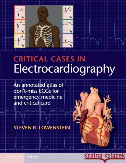 Critical Cases in Electrocardiography: An Annotated Atlas of Don't-Miss Ecgs for Emergency Medicine and Critical Care Steven R. Lowenstein 9781107535916