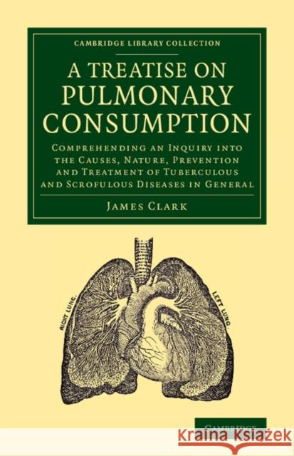 A Treatise on Pulmonary Consumption: Comprehending an Inquiry Into the Causes, Nature, Prevention and Treatment of Tuberculous and Scrofulous Diseases Clark, James 9781108062305 Cambridge University Press