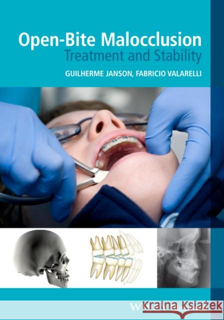 Open-Bite Malocclusion: Treatment and Stability Janson, Guilherme 9781118335987 John Wiley & Sons