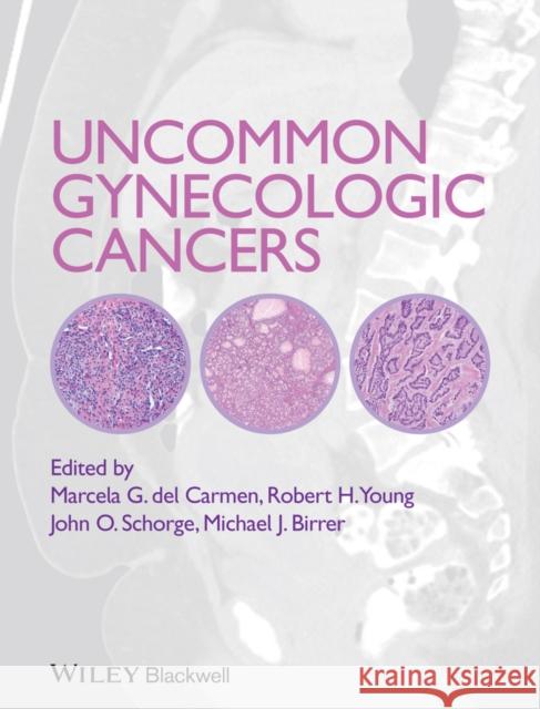 Uncommon Gynecologic Cancers  9781118655351 John Wiley & Sons
