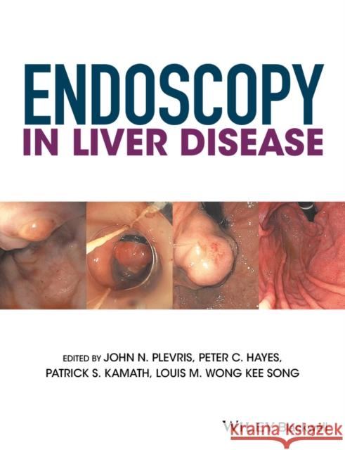 Endoscopy in Liver Disease John Plevris Peter Hayes Patrick Kamath 9781118660874 Wiley-Blackwell