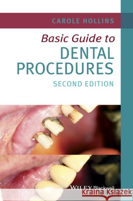 Basic Guide to Dental Procedures Carole Hollins 9781118924556 Wiley-Blackwell
