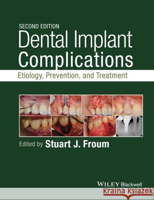 Dental Implant Complications: Etiology, Prevention, and Treatment Froum, Stuart 9781118976456 John Wiley & Sons