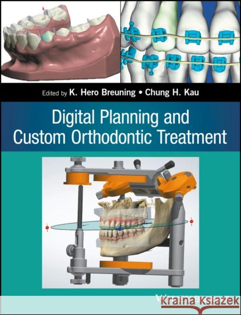 Digital Planning and Custom Orthodontic Treatment Kau, Chung How 9781119087779 John Wiley & Sons