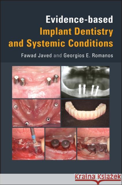 Evidence-Based Implant Dentistry and Systemic Conditions Javed, Fawad 9781119212249 Wiley-Blackwell