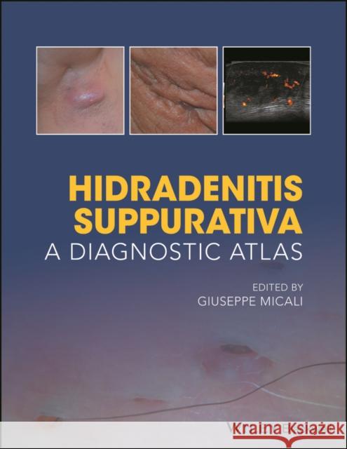 Hidradenitis Suppurativa: A Diagnostic Atlas Micali, Giuseppe 9781119272953