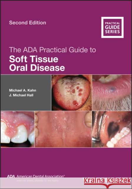 The ADA Practical Guide to Soft Tissue Oral Disease Michael A. Kahn J. Michael Hall 9781119437338 Wiley-Blackwell