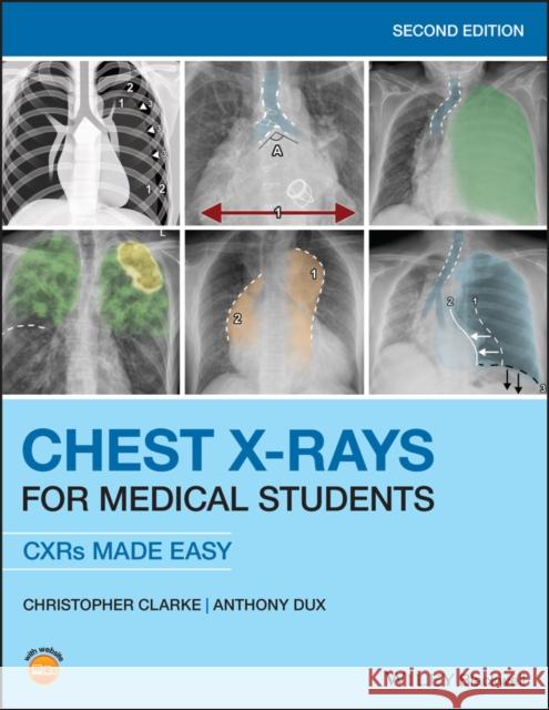 Chest X-Rays for Medical Students: Cxrs Made Easy Clarke, Christopher 9781119504153 Wiley-Blackwell