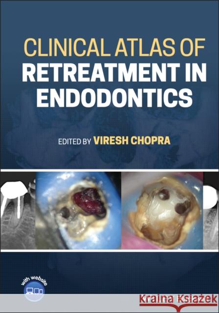 Clinical Atlas of Retreatment in Endodontics Viresh Chopra 9781119509202 Wiley-Blackwell