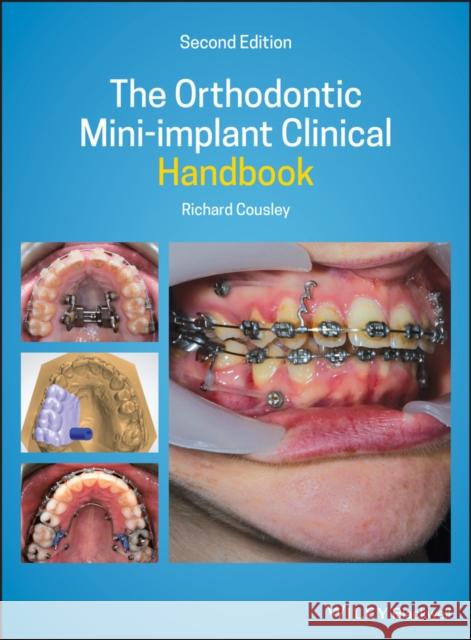 The Orthodontic Mini-Implant Clinical Handbook Cousley, Richard 9781119509752 John Wiley and Sons Ltd