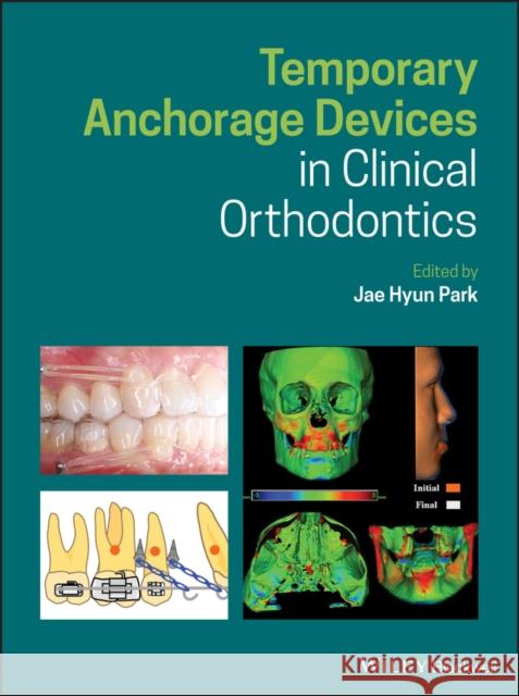 Temporary Anchorage Devices in Clinical Orthodontics Jae Hyun Park 9781119513476