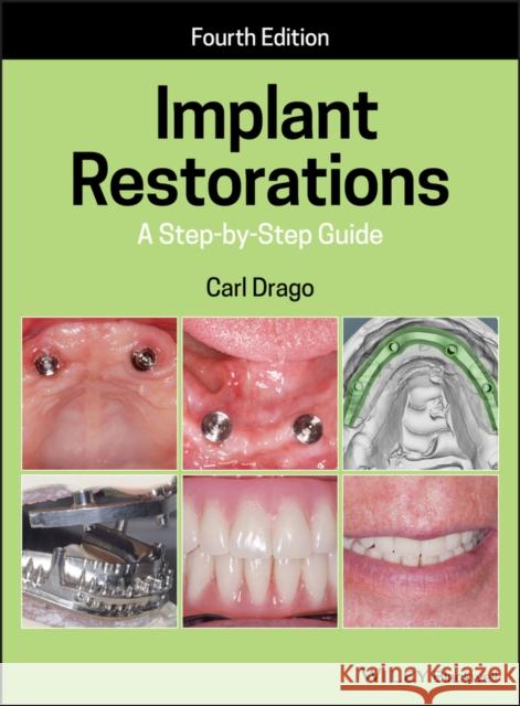 Implant Restorations: A Step-By-Step Guide Drago, Carl 9781119538110 Wiley-Blackwell