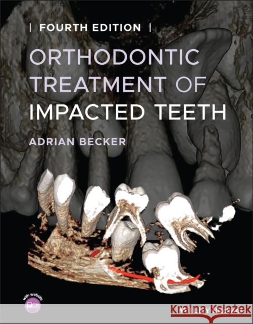 Orthodontic Treatment of Impacted Teeth Adrian Becker 9781119565376 Wiley-Blackwell