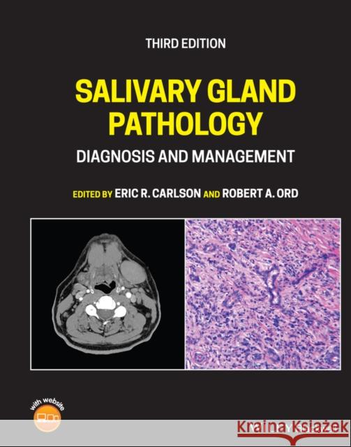 Salivary Gland Pathology: Diagnosis and Management Robert A. Ord Robert A. Ord 9781119730187 Wiley-Blackwell