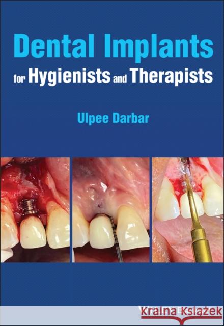 Dental Implants for Hygienists and Therapists Ulpee R. Darbar 9781119763826 John Wiley and Sons Ltd