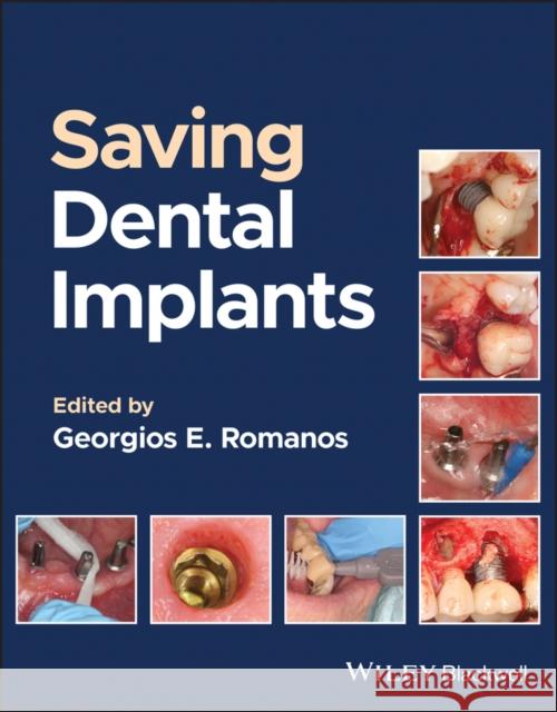 Saving Dental Implants  9781119807018 