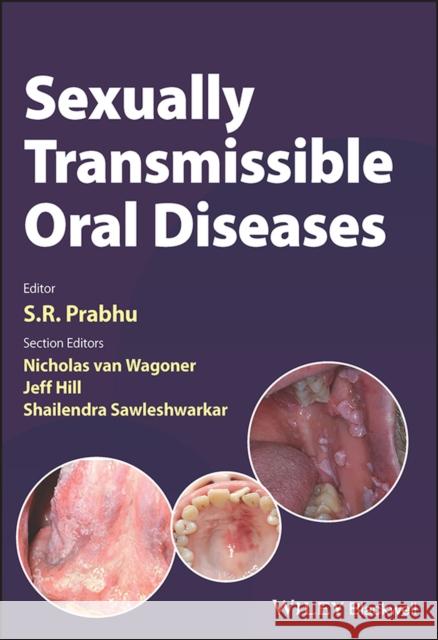 Sexually Transmissible Oral Diseases SR Prabhu 9781119826750