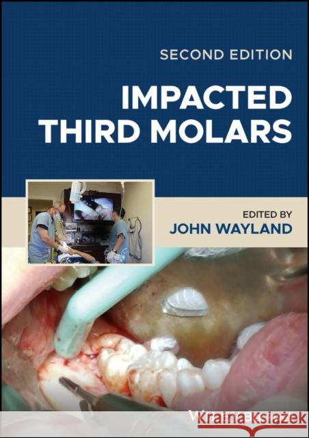 Impacted Third Molars Wayland 9781119930303 John Wiley and Sons Ltd