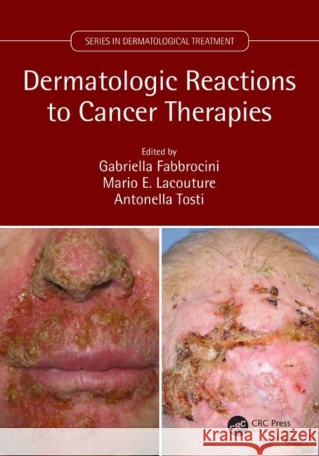 Dermatologic Reactions to Cancer Therapies Gabriella Fabbrocini Mario E. Lacouture Antonella Tosti 9781138035539