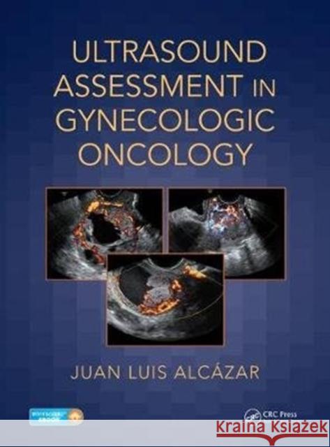 Ultrasound Assessment in Gynecologic Oncology  9781138044326 CRC Press