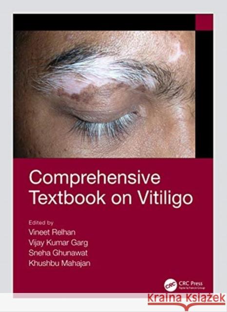 Comprehensive Textbook on Vitiligo Vijay Kumar Garg Vineet Relhan 9781138063594