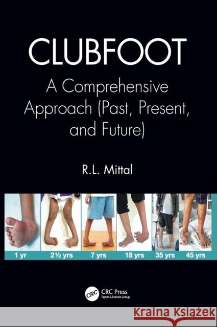 Clubfoot: A Comprehensive Approach (Past, Present, and Future) R. L. Mittal 9781138083738 CRC Press